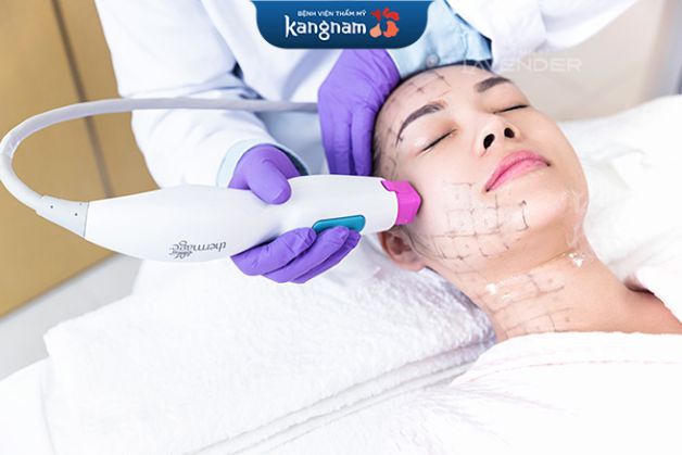 Máy nâng cơ Thermage thế hệ mới có gì khác so với công nghệ cũ? Nâng cơ Thermage FLX