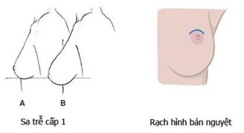 Với trường hợp vú xệ cấp độ 1, bác sĩ áp dụng kĩ thuật rạch bán nguyệt ở quầng vú ngực bị chảy xệ phải làm sao