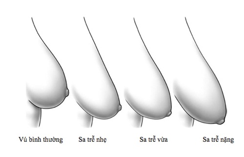 Các cấp độ ngực xệ vú sệ