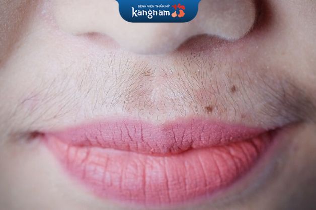 Mọc ria mép xuất phát từ nhiều lý do khác nhau, bạn cần hiểu rõ để có hướng điều trị thích hợp