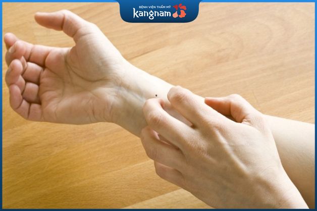 Vị trí nốt ruồi ở lưng cổ tay