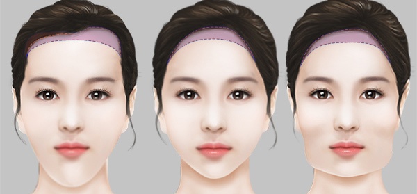 Hạ đường chân tóc là phương pháp hạ thấp đường viền chân tóc nhằm thu gọn trán