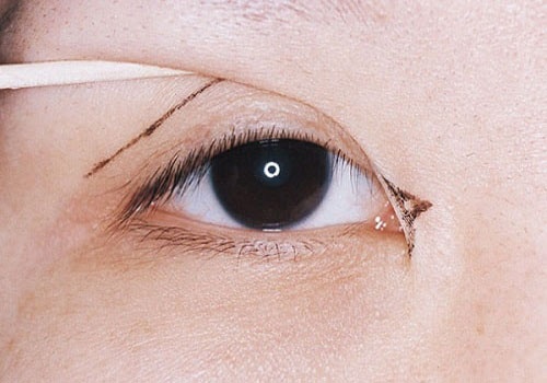 Chế độ hậu phẫu sai cách, không kiêng khem hợp lý