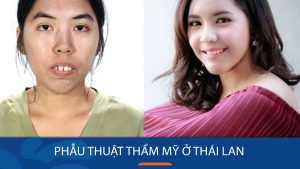 Review thực tế phẫu thuật thẩm mỹ ở Thái Lan Nên hay Không?