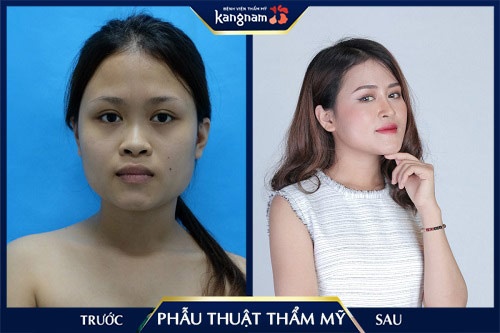 phẫu thuật thẩm mỹ sẹo lồi