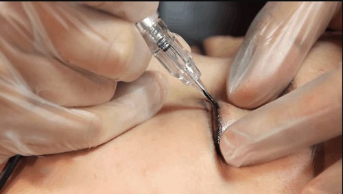 Phun mí bị sưng vài ngày đầu, không ảnh hưởng sinh hoạt