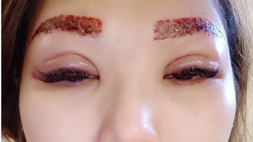 Phun mí mắt tại cơ sở nhỏ lẻ, kém chất lượng mang tới nhiều rủi ro về sức khỏe cho khách hàng phun mí xong bị ngứa