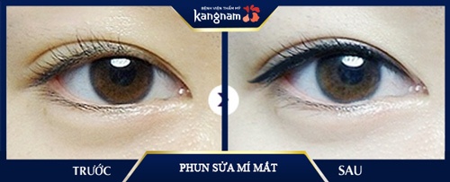 Đường viền mí sắc nét, thanh mảnh, đẹp tự nhiên phun sửa mí mắt bị hỏng