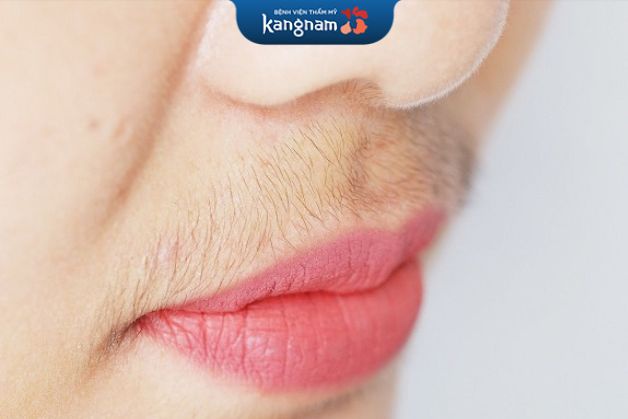 Ria mép nữ xuất hiện là do sự rối loạn hoocmon nội tiết trong cơ thể