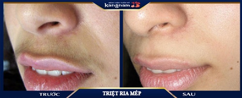 ria mép quá đậm phải làm sao