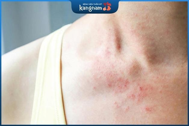 Tắm trắng tại nhà bằng kem tẩy rửa tiềm ẩn nhiều rủi ro