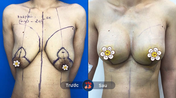 Hình ảnh trước và sau khi khắc phục vú xệ