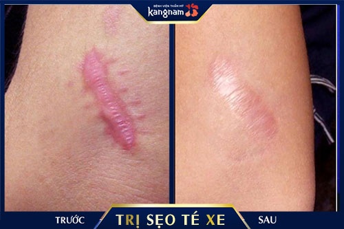 trị sẹo bị té xe Kết quả trước và sau khi khách hàng trị sẹo tại Kangnam