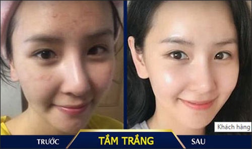 tác hại tắm trắng