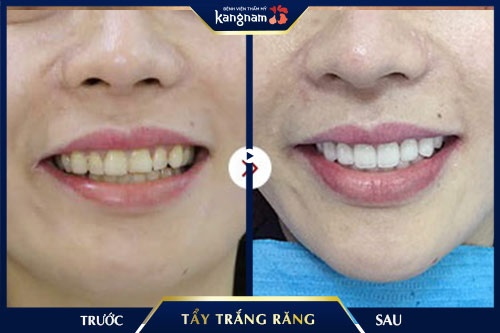 tẩy trắng răng giá rẻ