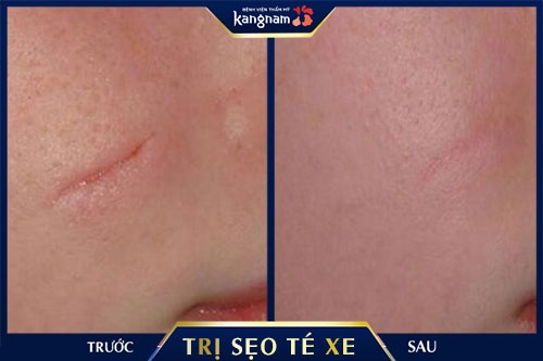 trị sẹo té xe webtretho Kết quả hoàn toàn khác biệt sau khi khách hàng trị sẹo tại Kangnam