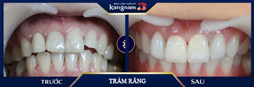 trám răng bị mẻ 
