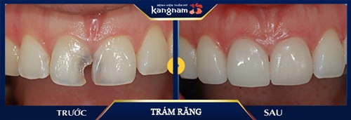 trám răng cửa giá bao nhiêu