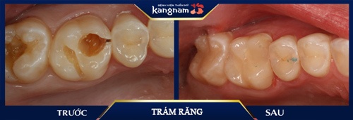 trám răng sâu lỗ to bao nhiêu tiền