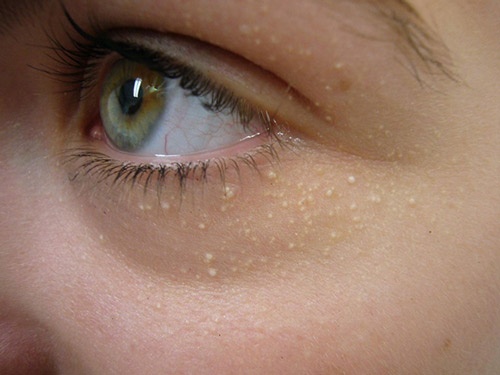 Cách trị mụn thịt tại nhà có nhiều ưu điểm nhưng cũng k ít các khuyết điểm trị mụn thịt tại nhà hiệu quả nhất