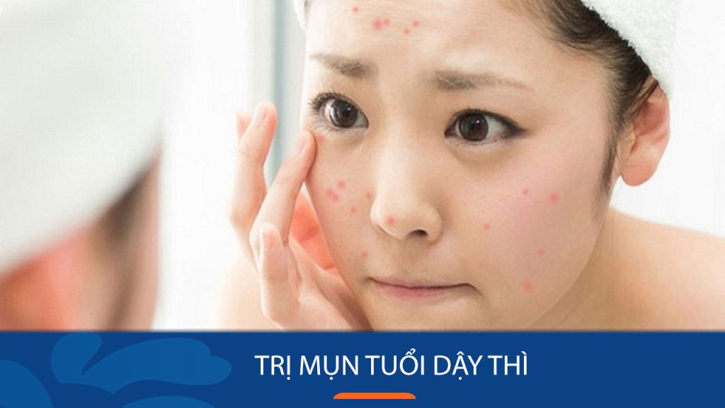 Đánh Bay Mụn Tuổi Dậy Thì Nhanh Chóng Chỉ Trong 7 Ngày – Không Còn Lo Vết Thâm