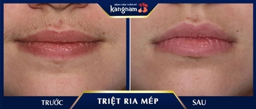 triệt ria mép vĩnh viễn