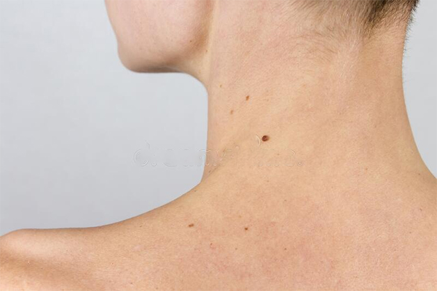 Nốt ruồi ở sau gáy lệch về bên trái nữ là người sống biết điều, không đòi hỏi