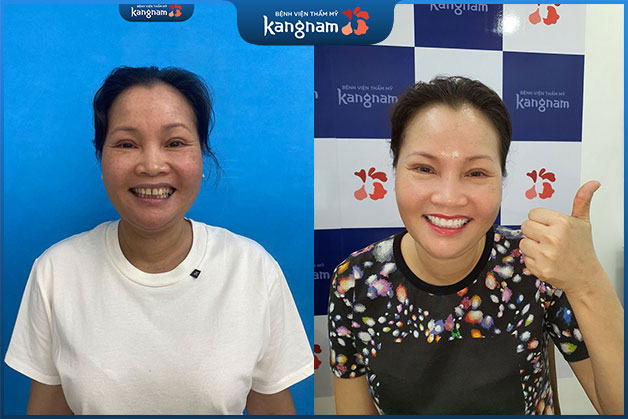 Bác Thoa vô cùng hài lòng với hàm răng sau tẩy trắng