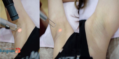 bắn laser trị thâm nách bắn laser trị thâm nách