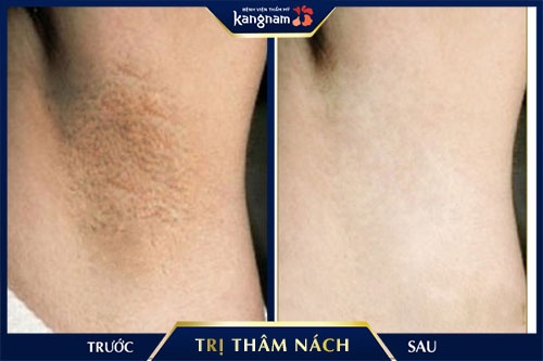 bắn laser trị thâm nách bắn laser trị thâm nách