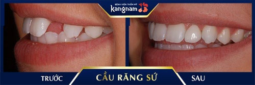 bảng giá cầu răng sứ bảng giá cầu răng sứ