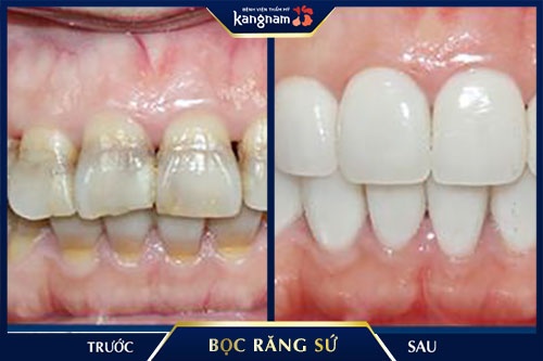 bệnh mòn cổ răng bệnh mòn cổ răng