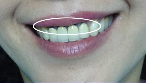 Bọc răng sứ kim loại gây đen viền nướu, ảnh hưởng trực tiếp đến thẩm mỹ bọc răng sứ bị đen nướu