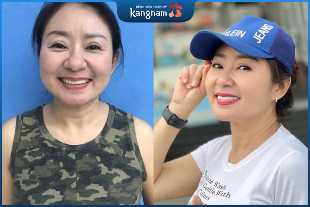 Cô Thoa tự tin hơn khi cười với hàm răng trắng sáng