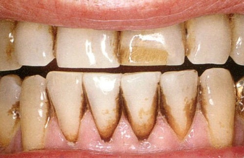 Trường hợp đen chân răng do hút thuốc hoặc uống nhiều cà phê, nước chè răng bị đen ở chân răng