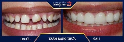 Trường hợp chị Lý (Bắc Giang) có khuôn hàm rộng, răng nhỏ nên dẫn tới tình trạng thưa cả hàm. Sau khám, kiểm tra bác sĩ đã chỉ định phương pháp trám răng kết hợp bọc sứ để cải thiện toàn bộ tình trạng cách chữa răng cửa thưa