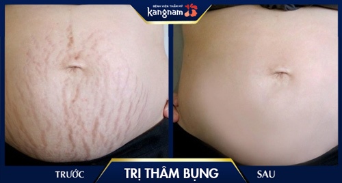 cách trị thâm bụng sau khi sinh hiệu quả cách trị thâm bụng sau khi sinh