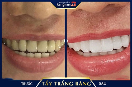 cách trị buốt răng sau khi tẩy trắng