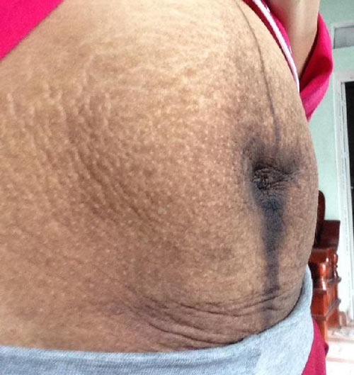 Tình trạng thâm rạn sau sinh gây ảnh hưởng nghiêm trọng đến thẩm mỹ trị thâm vùng bụng sau sinh