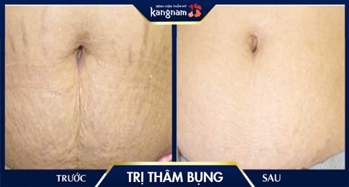 Xóa bỏ hoàn toàn vết thâm rạn sau sinh bằng thế hệ Laser hiện đại trị thâm bụng sau sinh
