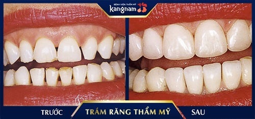 cách tự trám răng tại nhà