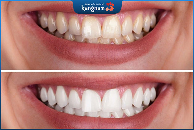 Kiêng các thực phẩm đậm màu sẽ giúp răng trắng sáng tốt hơn