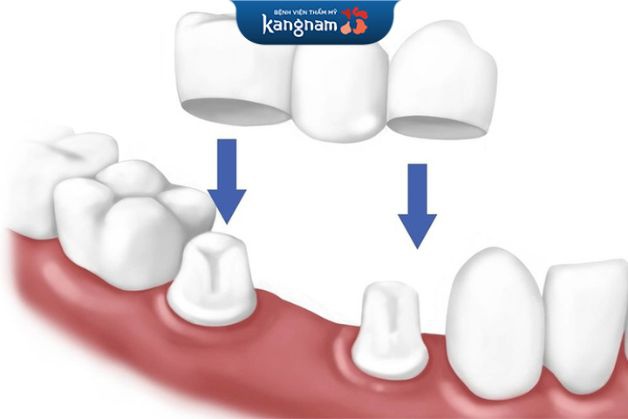 Cầu răng sứ là gì