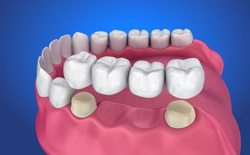 Giá làm cầu răng hợp lý, đáp ứng nhu cầu thẩm mỹ và độ bền lâu dài cho khách hàng cầu răng sứ bao nhiêu tiền