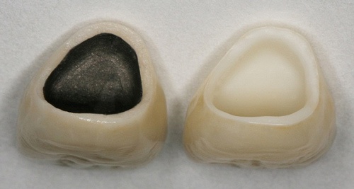 Bọc răng toàn sứ (phải) thay thế cho mão sứ kim loại (trái) để khắc phục tình trạng nướu răng bị đen chân nướu răng bị đen