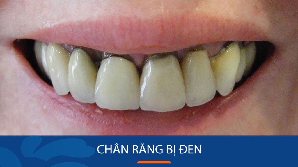 Chân răng bị đen thì phải làm sao? Nguyên nhân