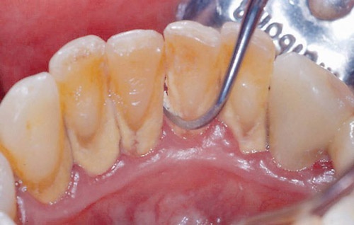 Cạo vôi răng bằng công nghệ siêu âm hiện đại là giải pháp tối ưu nhất chân răng bị đen và chảy máu