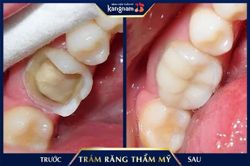 trám răng trẻ em