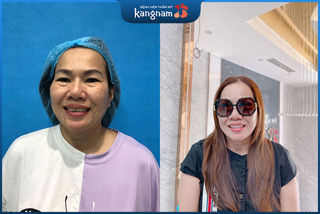 Cô Thu nở nụ cười rạng rỡ sau khi sở hữu hàm răng trắng sáng toàn diện