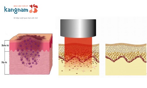 điều trị thâm mông bằng laser